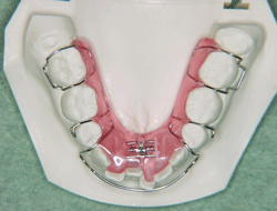 床矯正の装置（下顎）