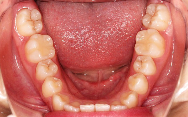 浦安市の歯医者　矯正歯科　あらかわ歯科医院　インビザライン治療例
