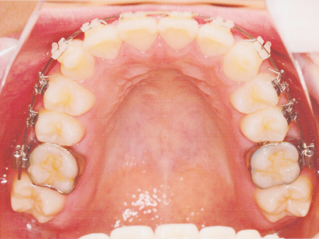 浦安の歯医者　矯正歯科　あらかわ歯科医院　ワイヤー矯正 