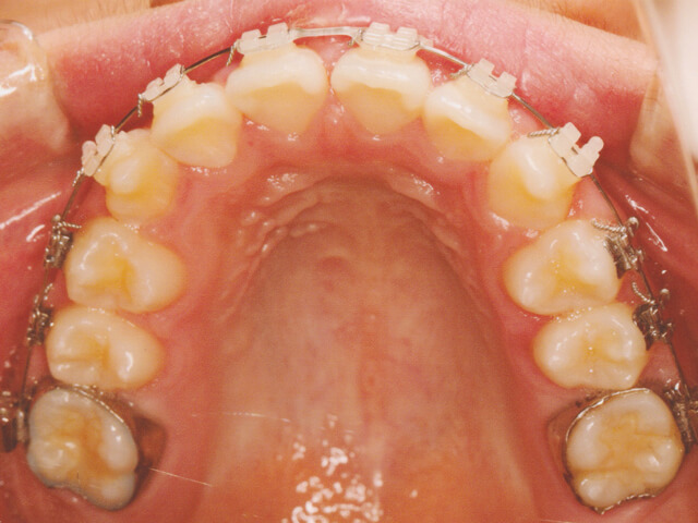 浦安の歯医者　矯正歯科　あらかわ歯科医院　ワイヤー矯正 