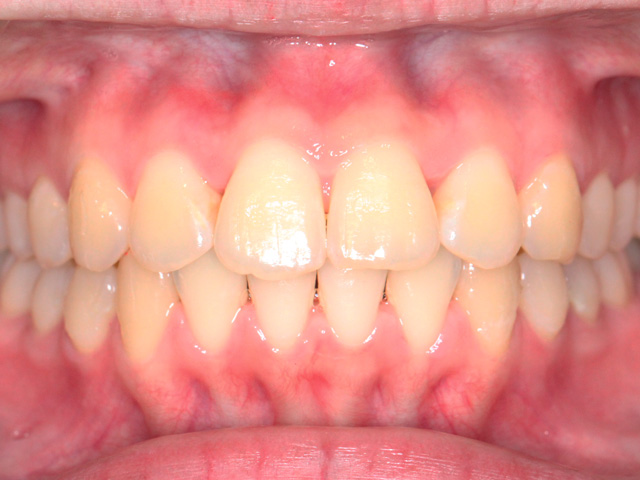 浦安市の歯医者 矯正歯科 あらかわ歯科医院 インビザライン症例