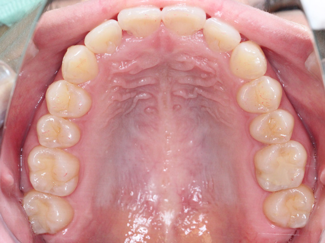 浦安市の歯医者 矯正歯科 あらかわ歯科医院 インビザライン症例