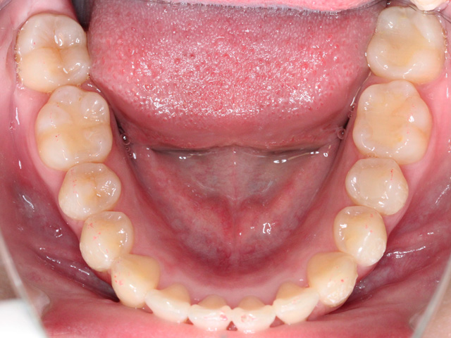 浦安市の歯医者 矯正歯科 あらかわ歯科医院 インビザライン症例