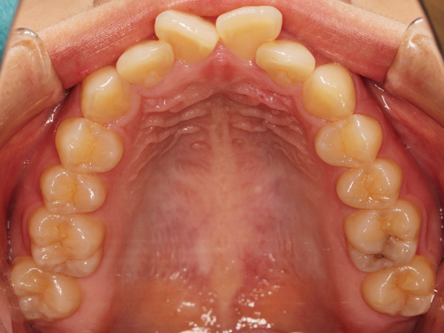 浦安市の歯医者 矯正歯科 あらかわ歯科医院 インビザライン症例