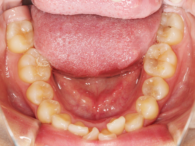 浦安市の歯医者 矯正歯科 あらかわ歯科医院 インビザライン症例