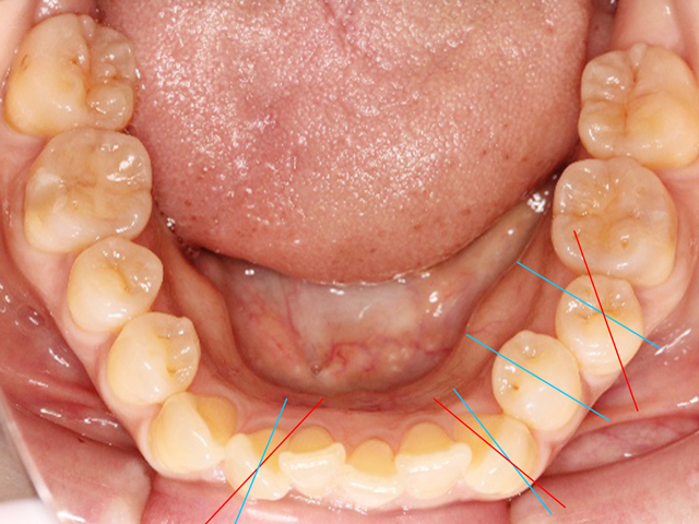 浦安市の歯医者 矯正歯科 あらかわ歯科医院 インビザライン症例