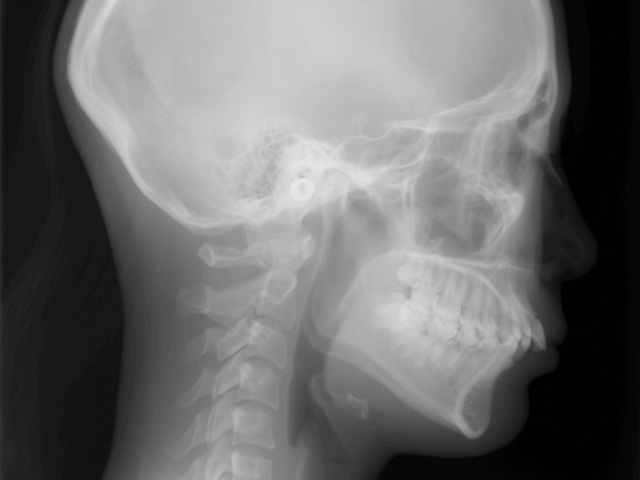 浦安市の歯医者 矯正歯科 あらかわ歯科医院 インビザライン症例