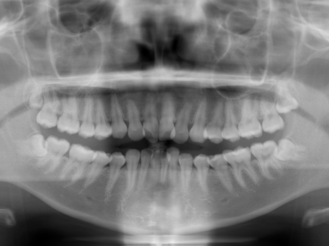 浦安市の歯医者 矯正歯科 あらかわ歯科医院 インビザライン症例