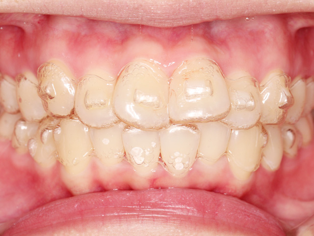 浦安市の歯医者 矯正歯科 あらかわ歯科医院 インビザライン症例