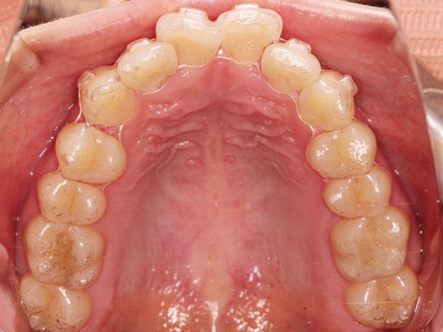 浦安市の歯医者 矯正歯科 あらかわ歯科医院 インビザライン症例