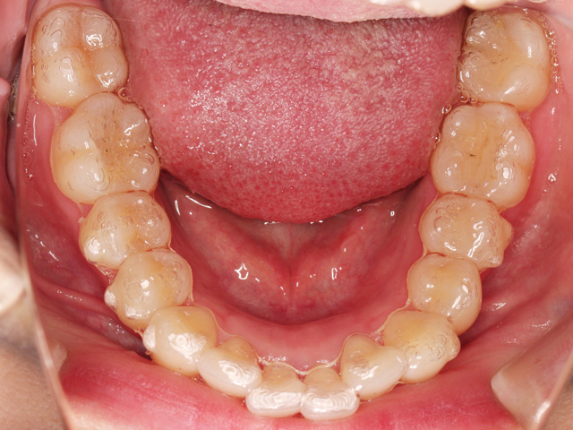 浦安市の歯医者 矯正歯科 あらかわ歯科医院 インビザライン症例