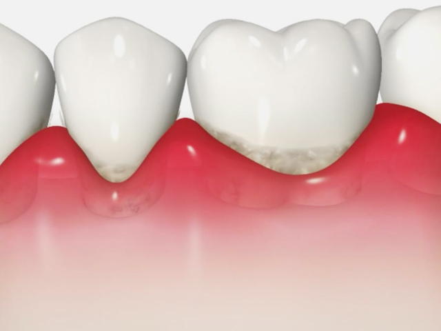 浦安市の歯医者 矯正歯科 あらかわ歯科医院 歯周病治療