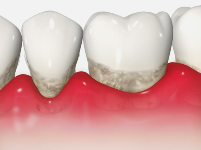 浦安市の歯医者 矯正歯科 あらかわ歯科医院 歯周病治療