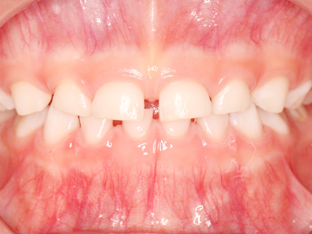 浦安の歯医者 矯正歯科 あらかわ歯科医院 小児矯正