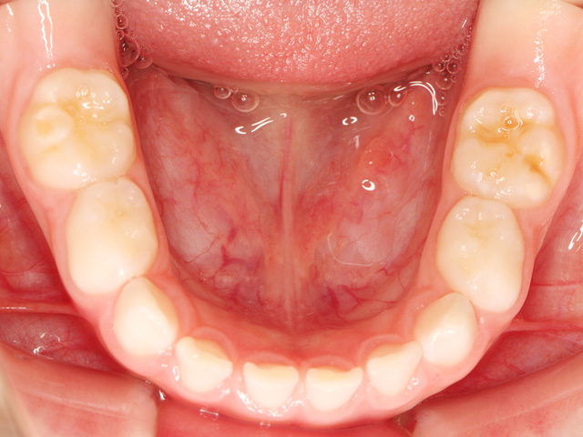 浦安の歯医者 矯正歯科 あらかわ歯科医院 小児矯正