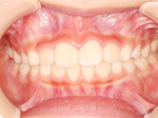 浦安の歯医者 矯正歯科 あらかわ歯科医院 小児矯正