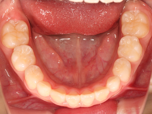 浦安の歯医者 矯正歯科 あらかわ歯科医院 小児矯正