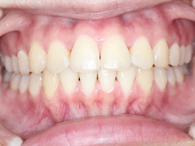 浦安の歯医者 矯正歯科 あらかわ歯科医院 小児矯正