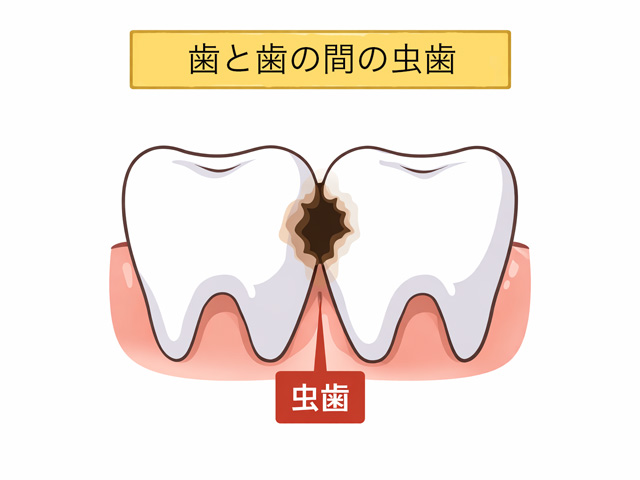 浦安市の歯医者 矯正歯科 あらかわ歯科医院 デンタルフロスが臭う理由